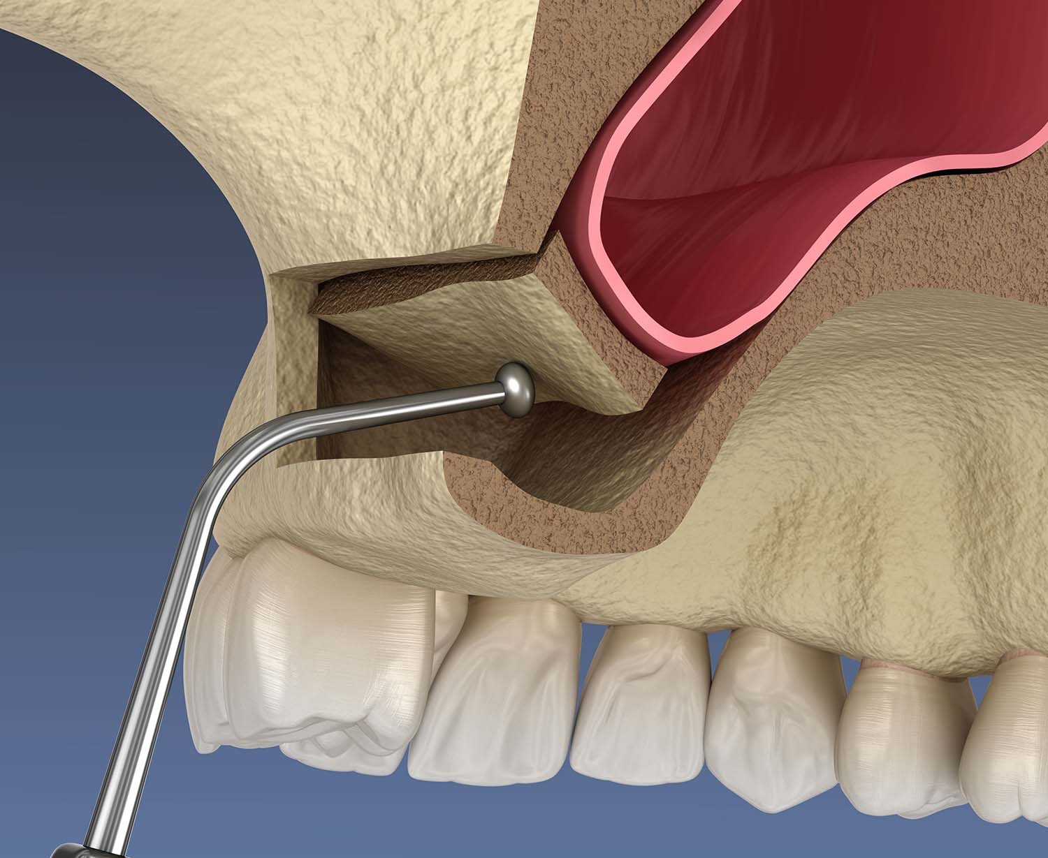 Podizanje poda maksilarnog sinusa (sinus lift)