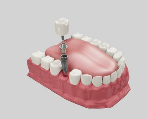 Ugradnja zubnih implantata